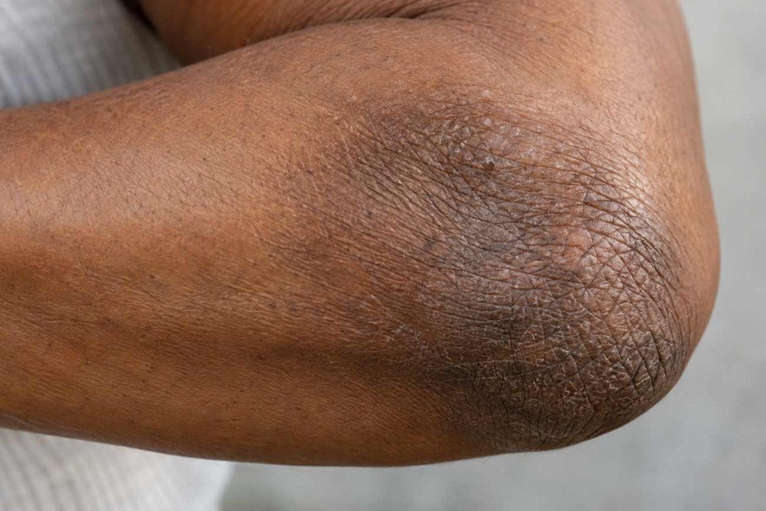 Gomiti scuri e ruvidi: perché cambiano colore e come renderli più morbidi