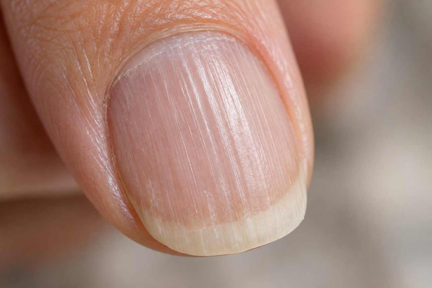 Perché compaiono le righe sulle unghie: cosa significano e quando preoccuparsi